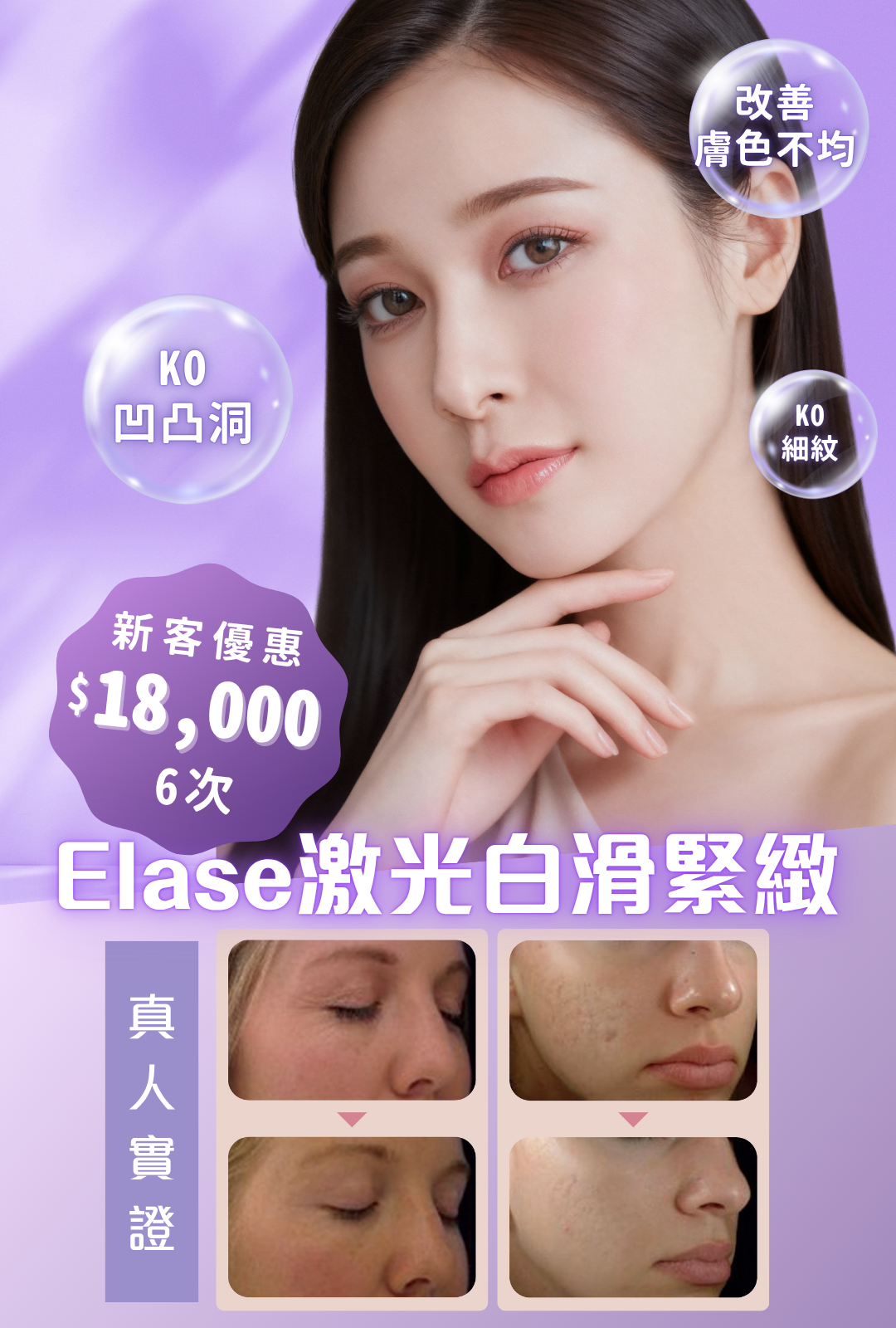 Elase激光白滑緊緻