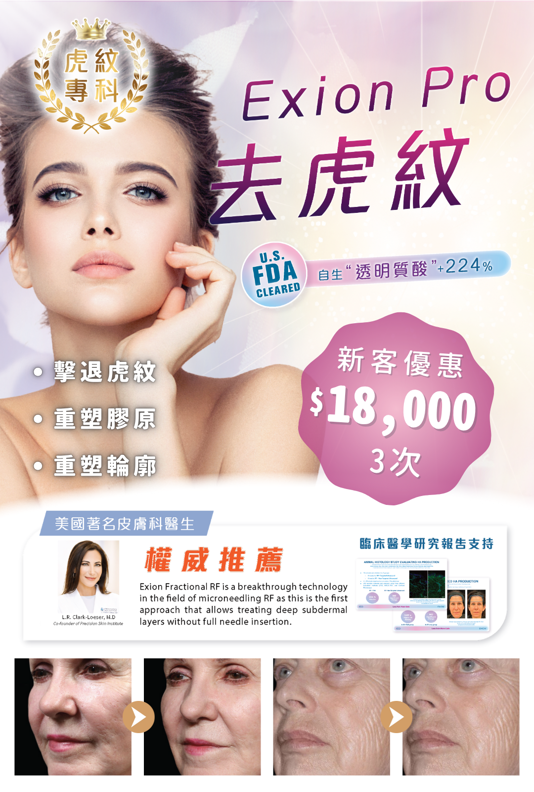 Exion Pro 去虎紋