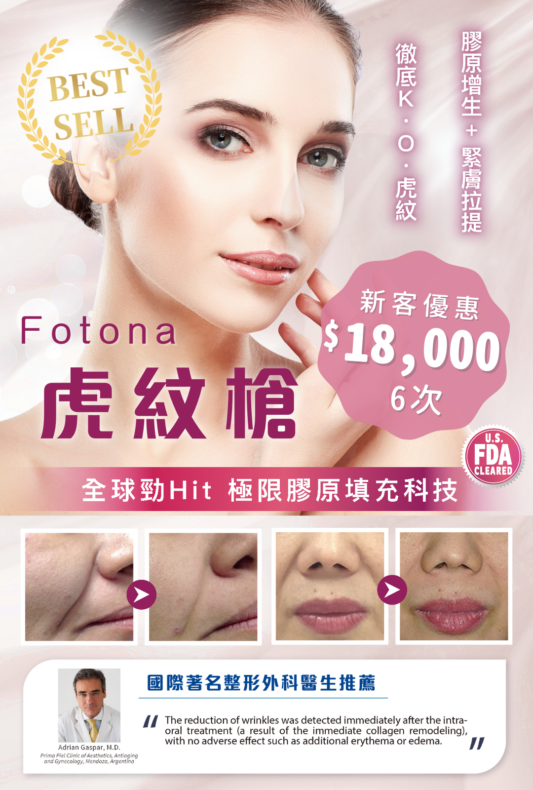 Fotona虎紋槍