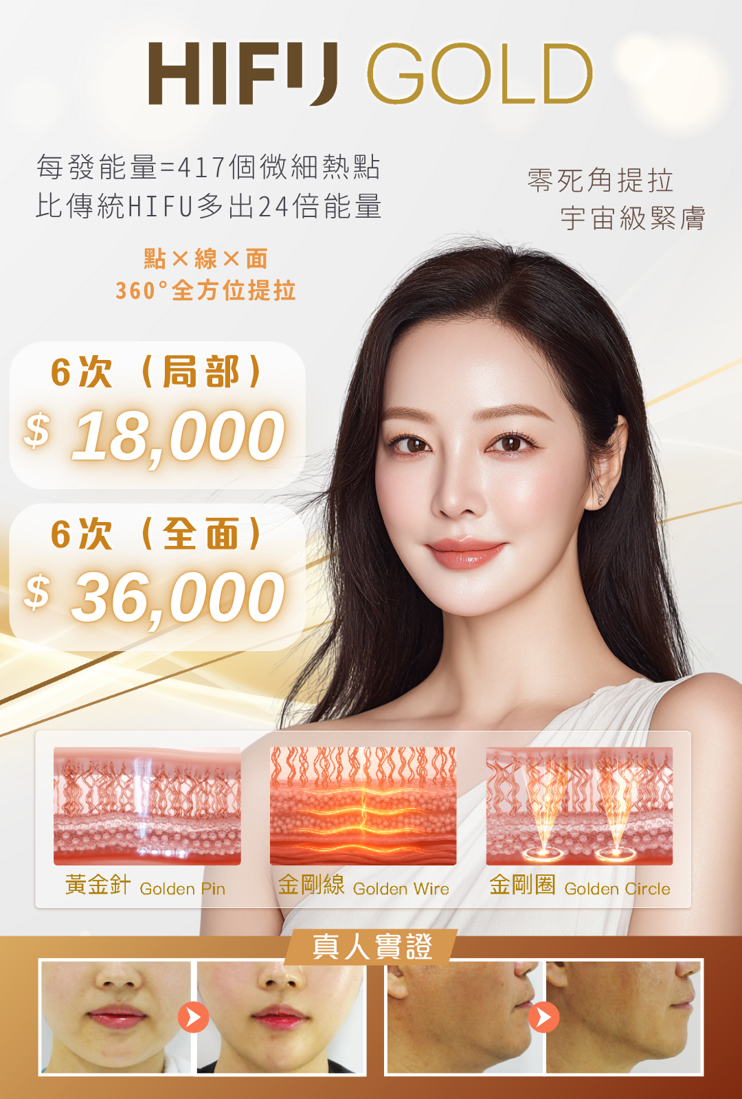 HIFU GOLD
